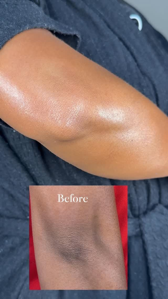 Hyper pigmentation 3 piece set