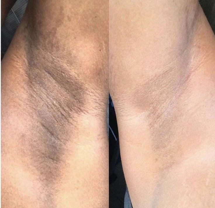 Hyper pigmentation 3 piece set